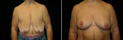 Bariatric Breast Lift Patient 1