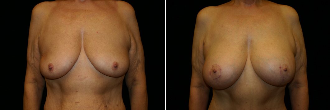 breast-lift-implant-01-01