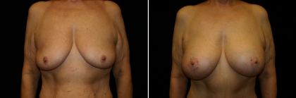 Bariatric Breast Lift with Implant Patient 1