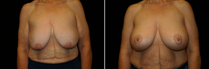 Bariatric Breast Lift with Implant Patient 2
