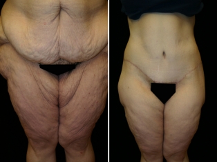 Bariatric Inner Thigh Lift Patient 1