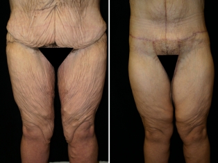 Bariatric Inner Thigh Lift Patient 2