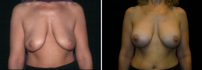 Breast Lift & Implant Enlargement Patient 5