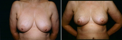 Breast Lift Patient 4