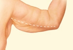 05_inner-arm-incision-01