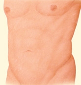 06_liposuction-07