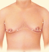 05_gynecomastia-liposuction-02