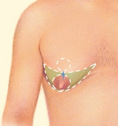 07_gynecomastia-excision-nipple-mov-01