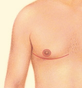 07_gynecomastia-excision-nipple-mov-02