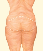 06_body-lift-incision-01