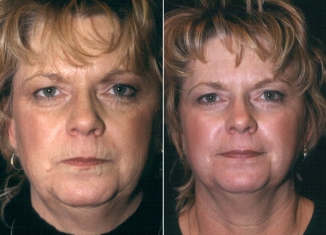 Facial Laser Resurfacing Patient 1