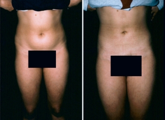 Liposuction Patient 2