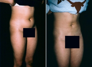 liposuction02-02