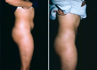 liposuction02-03