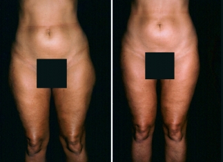 Liposuction Patient 3