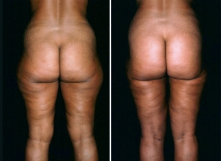 liposuction03-02
