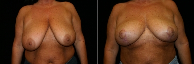 breast-mpxy03-01.jpg