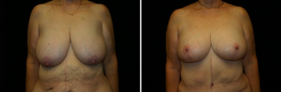 Breast Lift Patient 2 (After Weight Loss)