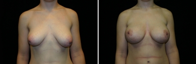 Breast Lift & Implant Enlargement Patient 1