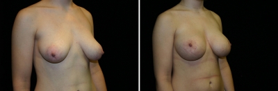 breast-mpxy-aug01-02a.jpg