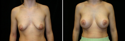 breast-mpxy-aug02-01.jpg