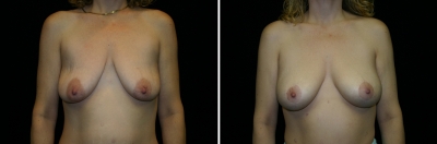 breast-mpxy-aug03-01.jpg