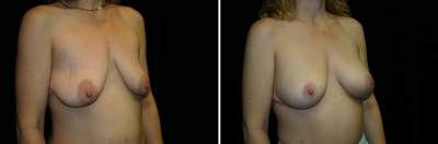 breast-mpxy-aug03-02.jpg