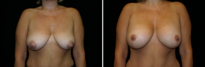 breast-mpxy-aug04-01.jpg
