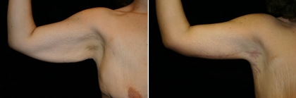 Arm Lift Patient 1