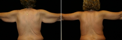 Bariatric Arm Lift Patient 1