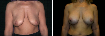 Breast Lift & Implant Enlargement Patient 5