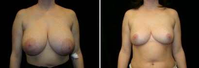 Breast Reduction Patient 1