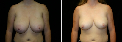 Breast Reduction Patient 2