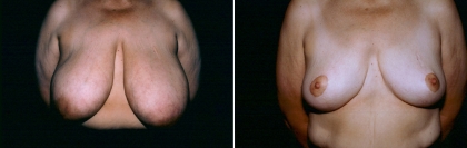 Breast Reduction Patient 3