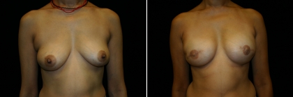 Tissue Expander & Implant Reconstruction Gallery