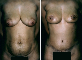 TRAM Flap Reconstruction Gallery