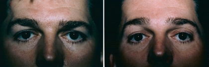Brow Lift Patient 3
