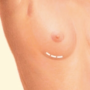 05_inframmary