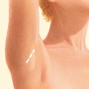 06_transaxillary