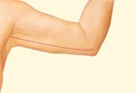 05_inner-arm-incision-closure-02
