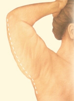 06_back-arm-incision-01