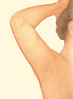06_back-arm-incision-closure-02