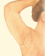 07_minimal-incision-01