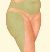 06_liposuction-02