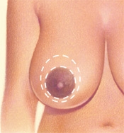 05_breast-red-circular-01