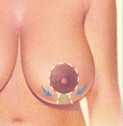 06_breast-red-vertical-01