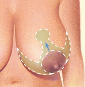 07_breast-red-anchor-01