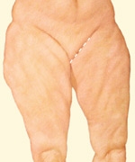 06_thigh-lift-medial-01