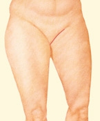 06_thigh-lift-medial-02