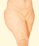 07_thigh-lift-outer-01